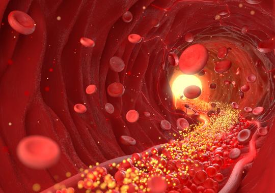 xMAP® Connect: Detecting Early Risk of Stroke with a Multiplex Immunoassay