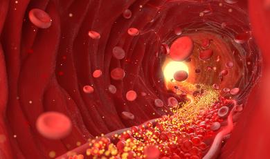 xMAP® Connect: Detecting Early Risk of Stroke with a Multiplex Immunoassay